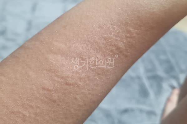 두드러기 치료 전 사진 — 대전점, 치료 기간 6개월