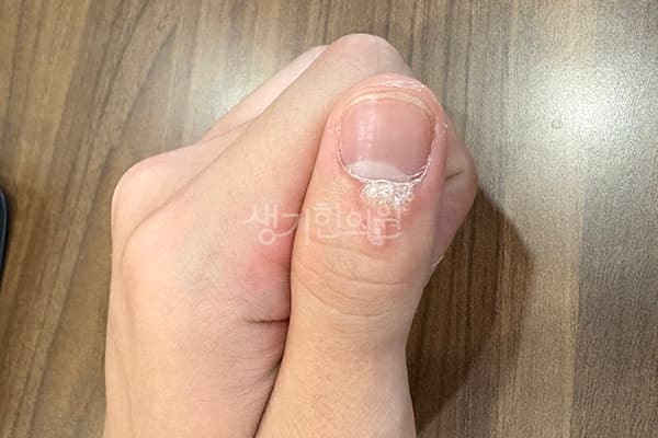 사마귀 치료 전 사진 — 부천점, 치료 기간 3개월