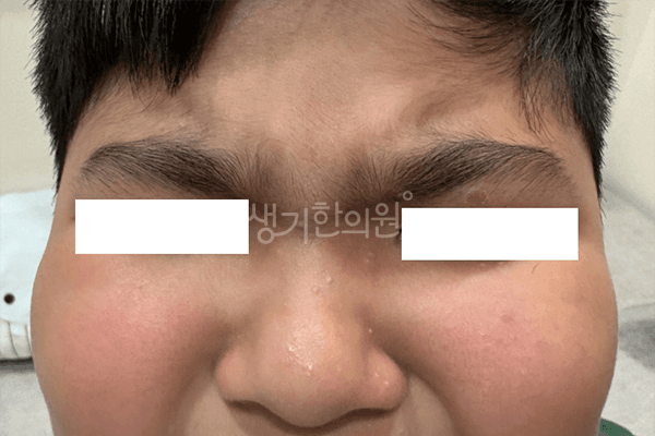 사마귀 치료 전 사진 — 부천점, 치료 기간 3개월