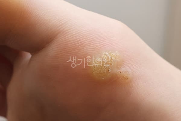 사마귀 치료 전 사진 — 대전점, 치료 기간 3개월