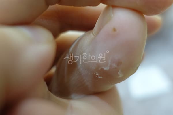 사마귀 치료 전 사진 — 노원점, 치료 기간 6개월