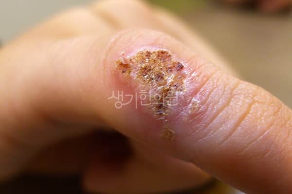 사마귀 치료 전 사진 — 노원점, 치료 기간 7개월