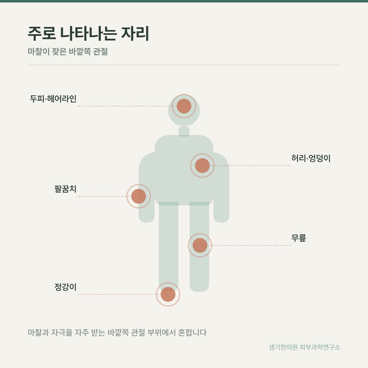 건선 호발 부위 안내 그림
