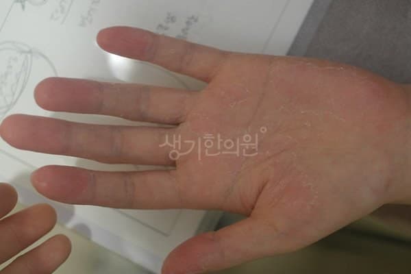 다한증 치료 전 사진 — 분당점, 팔,다리(손, 발), 20대 남, 치료 기간 3개월 치료전