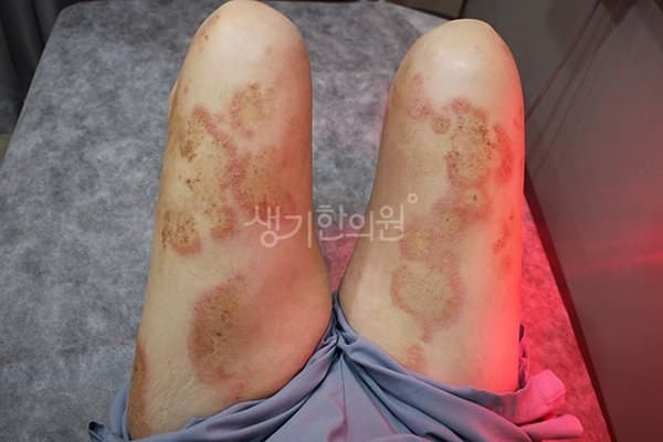 백선 치료 전 사진 — 수원점, 팔,다리(손, 발), 60대 이상 여, 치료 기간 6개월 치료전
