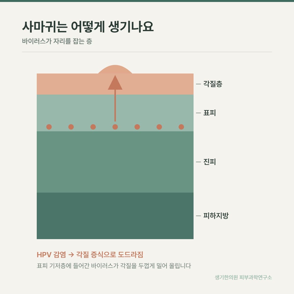 사마귀 발생 구조 안내 그림