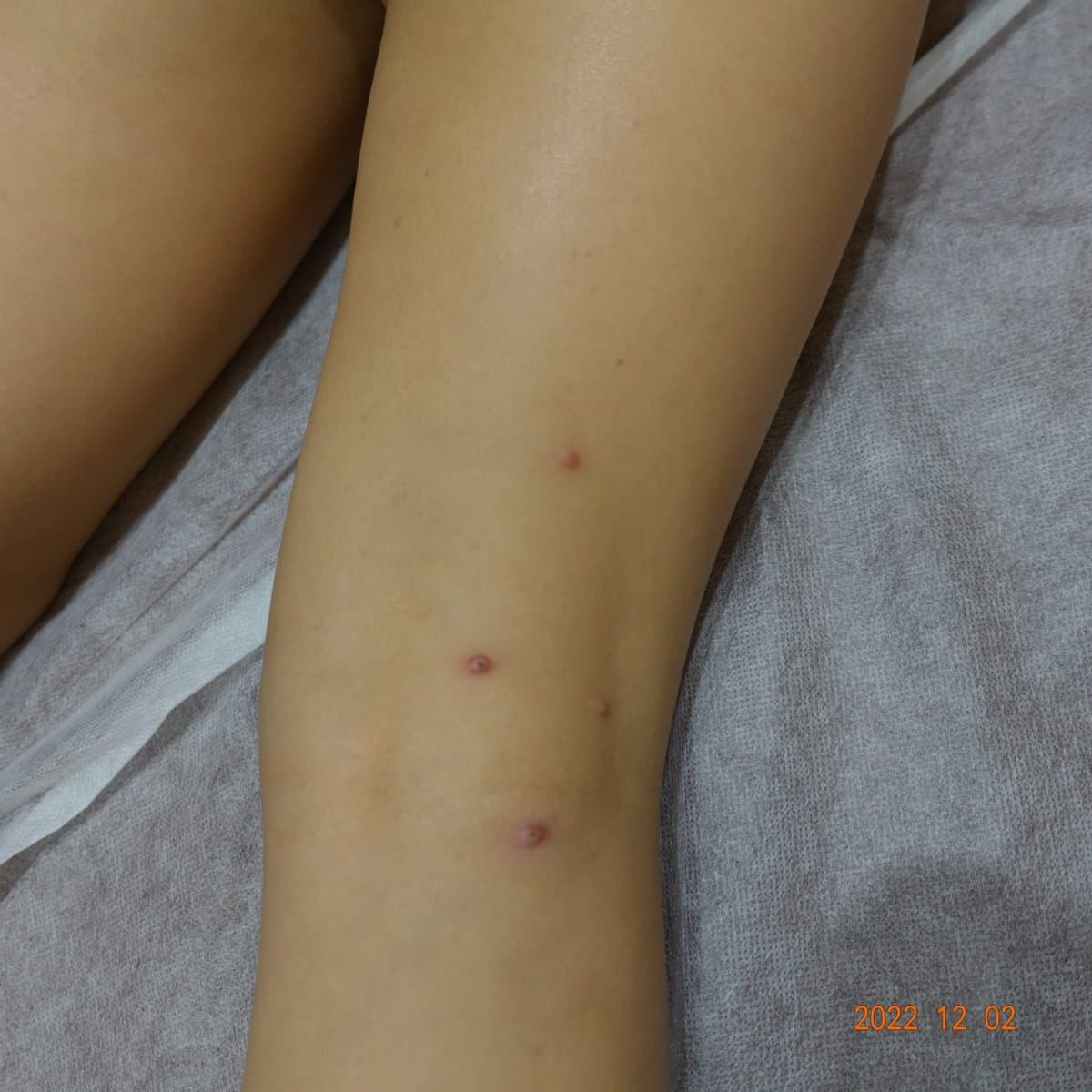 사마귀 치료 전 증상 물사마귀 팔 부위