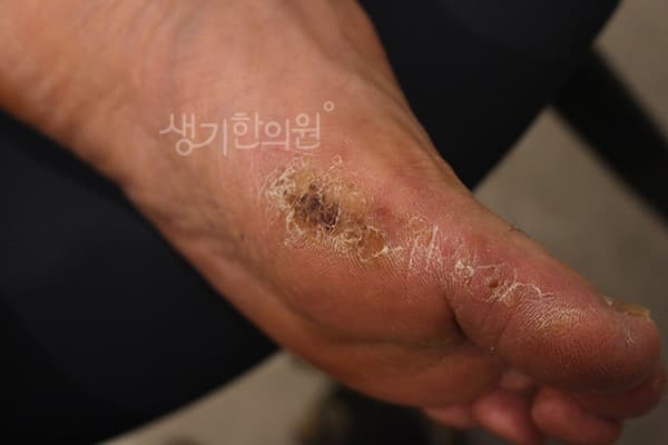 냉동치료를 여러 번 받은 뒤에도 남아 있는 발바닥 사마귀 치료 전 증상 — 부산서면점