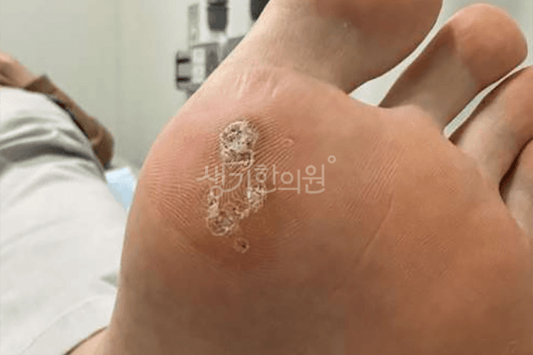 사마귀 치료 전 증상 발바닥 부위 — 부산서면점