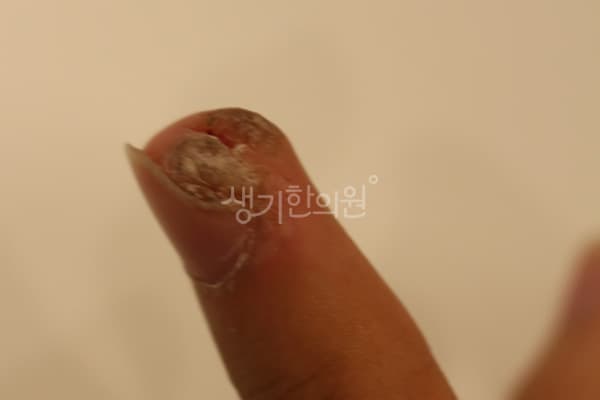 사마귀 치료 전 증상 손가락 끝과 손톱 주변 부위 — 부산서면점