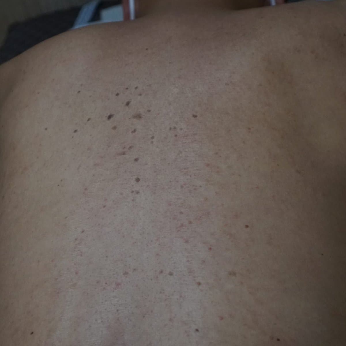 사마귀 치료 전 증상 편평사마귀 등 부위