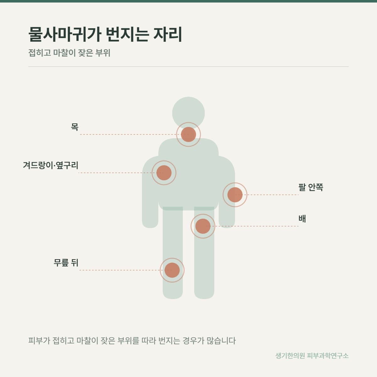 사마귀 호발 부위 안내 그림