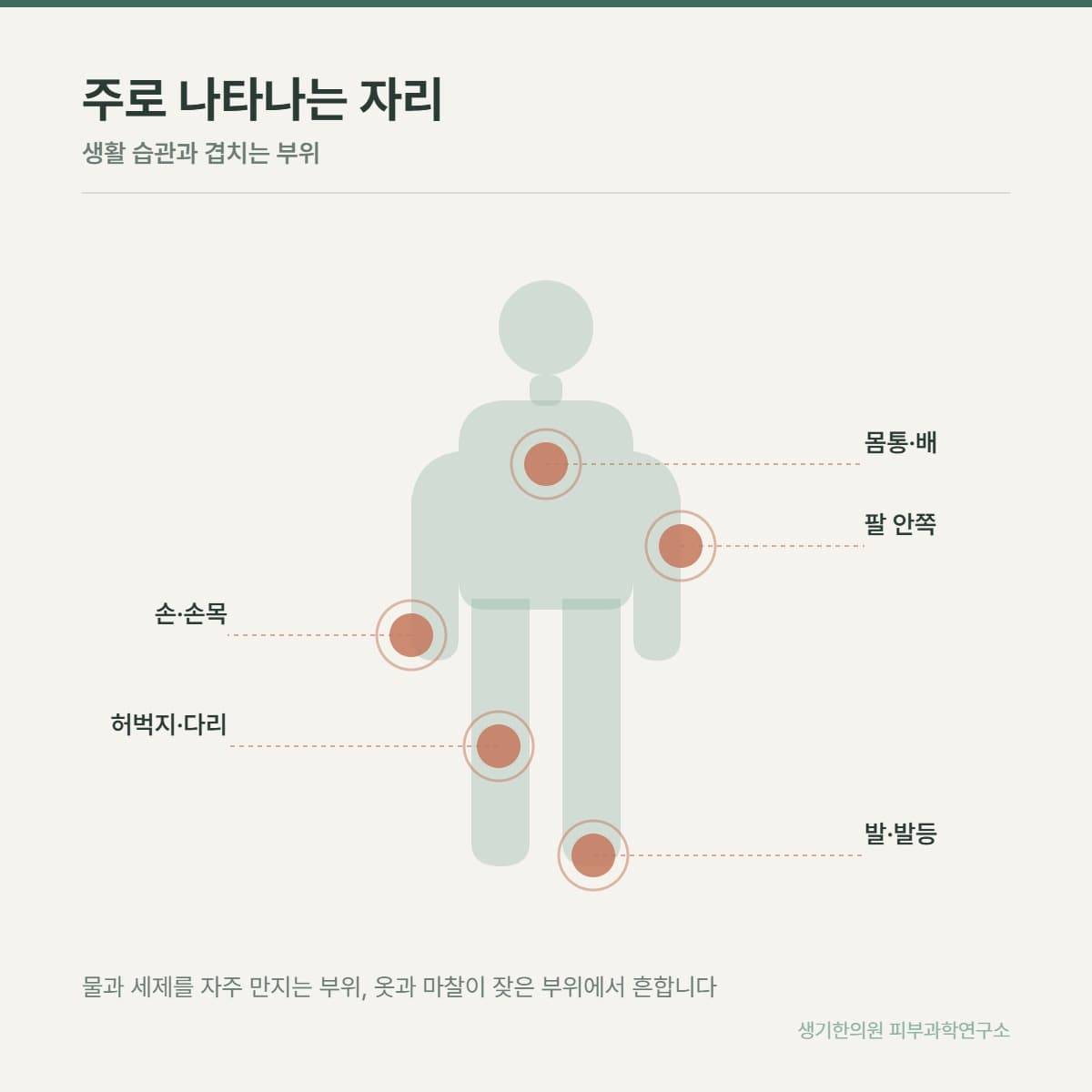 습진 호발 부위 안내 그림