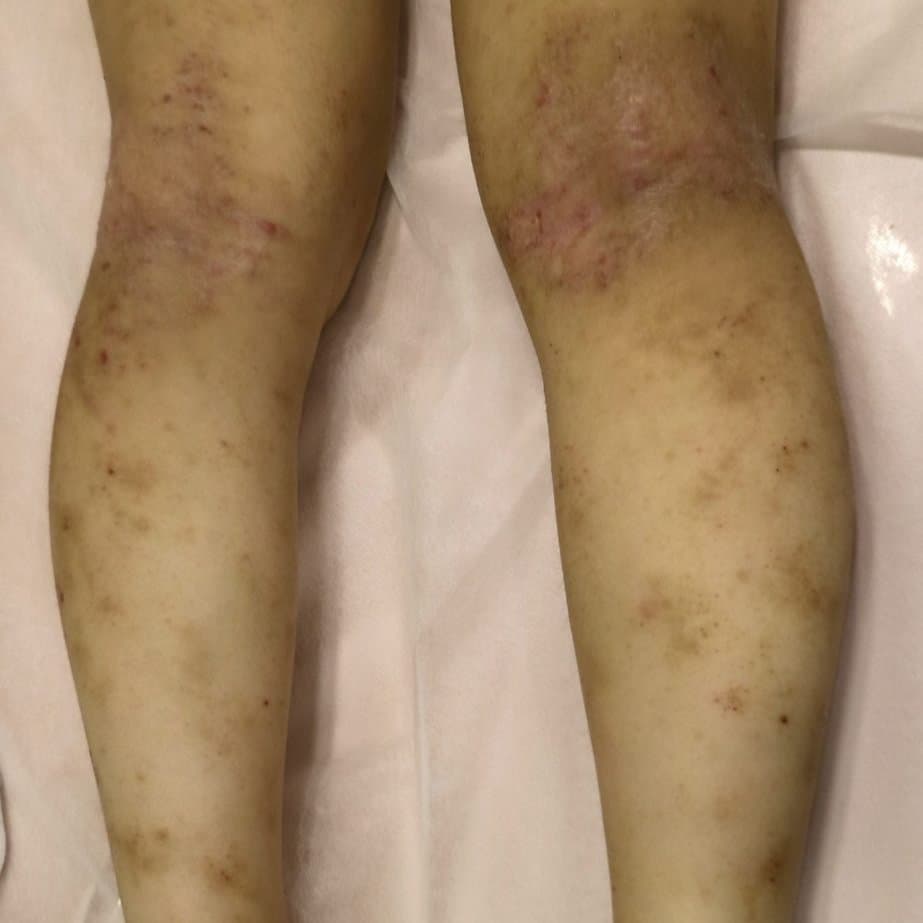 아토피 치료 전 증상 양쪽 다리 부위