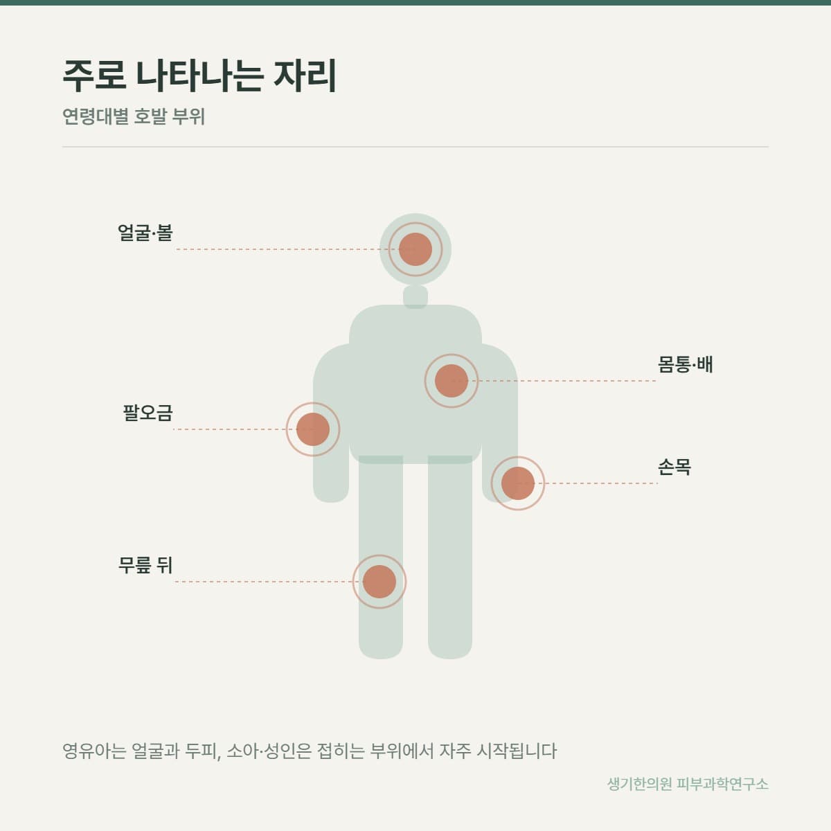 아토피 호발 부위 안내 그림