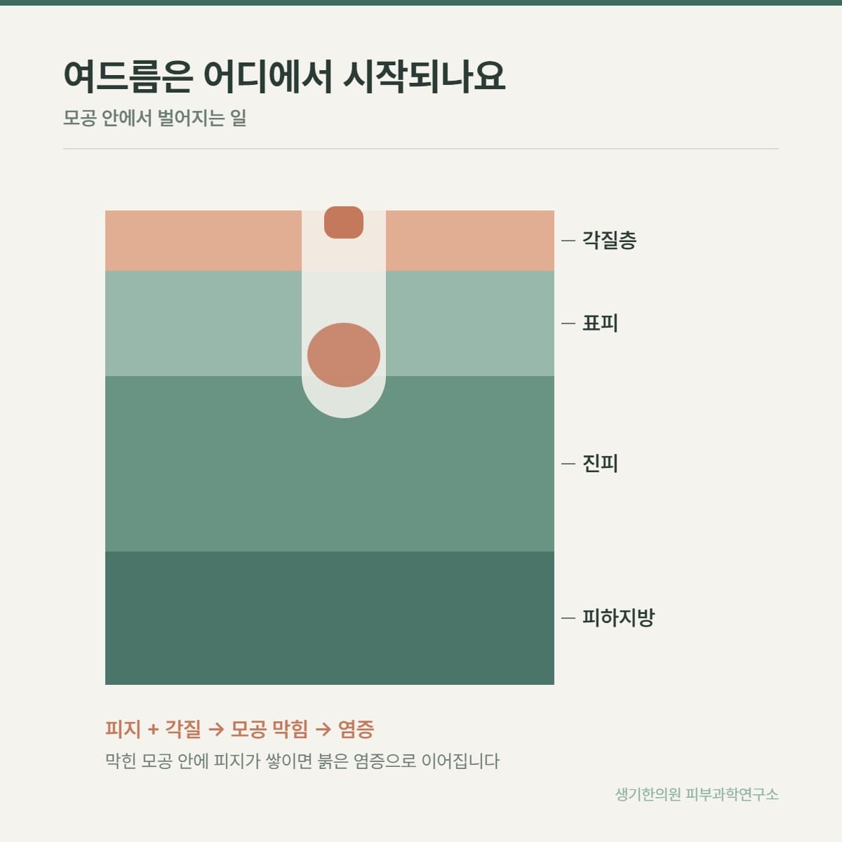 여드름 발생 구조 안내 그림