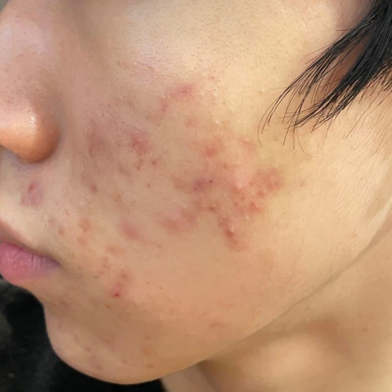 여드름 치료 전 증상 볼과 턱 부위
