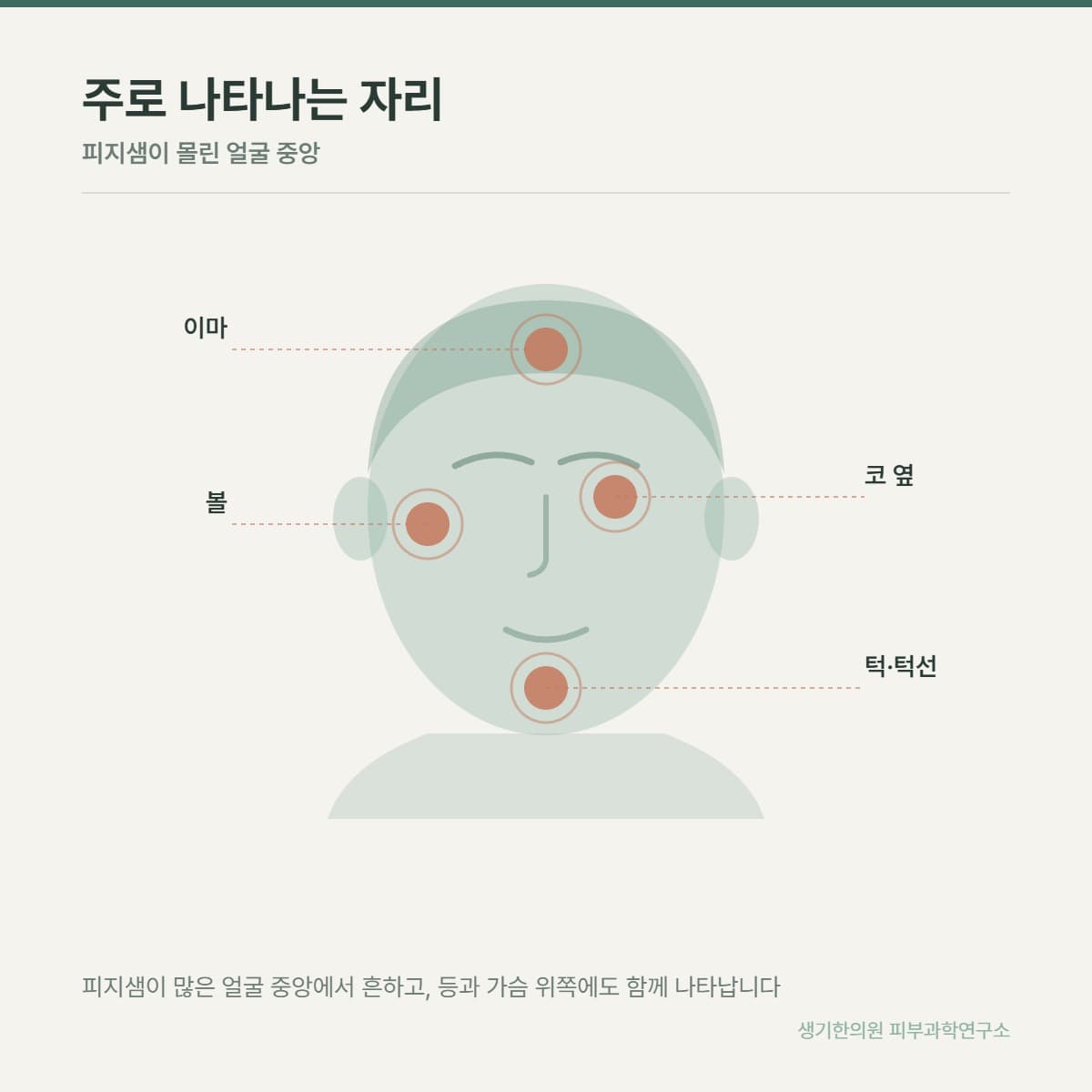 여드름 호발 부위 안내 그림