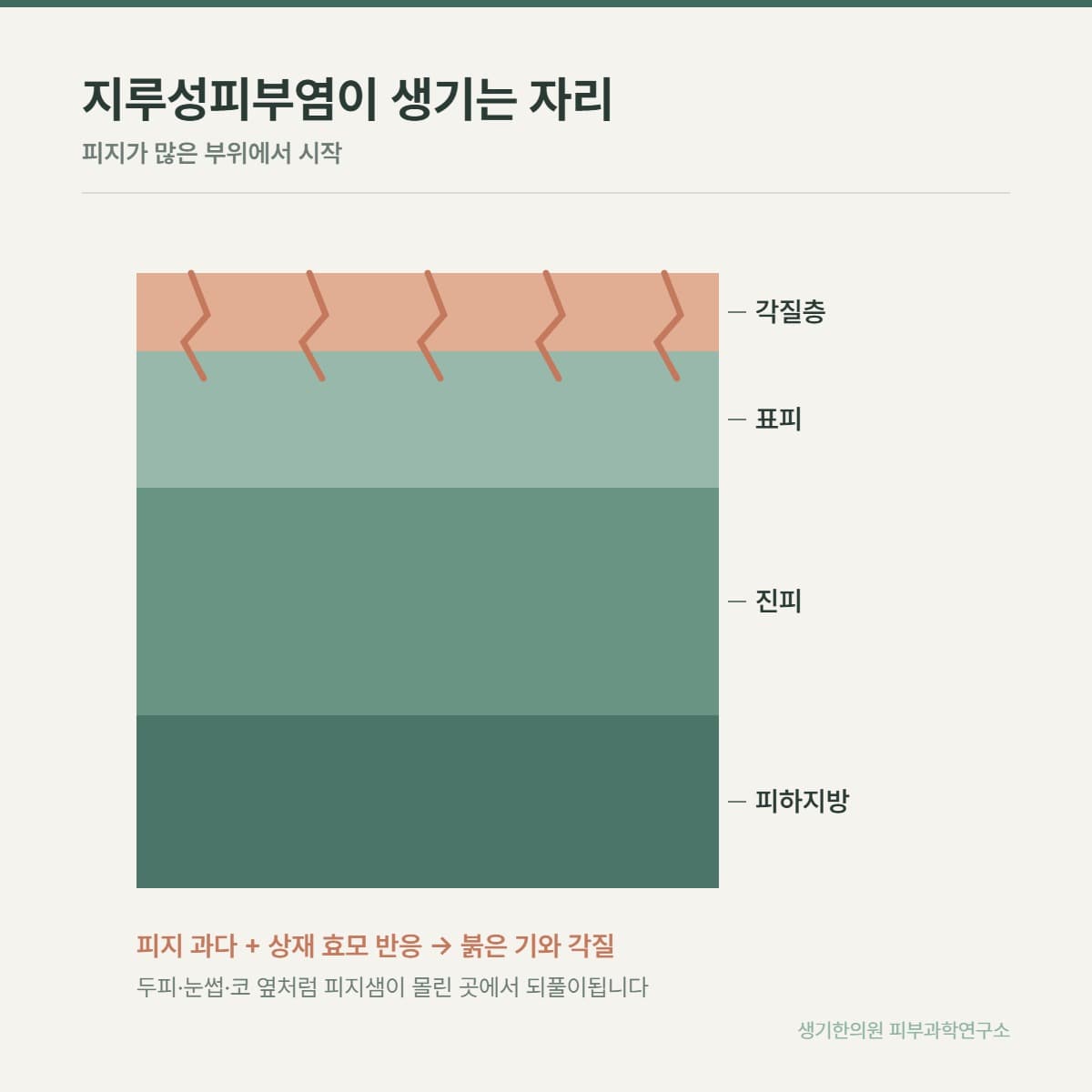 지루성피부염 발생 구조 안내 그림