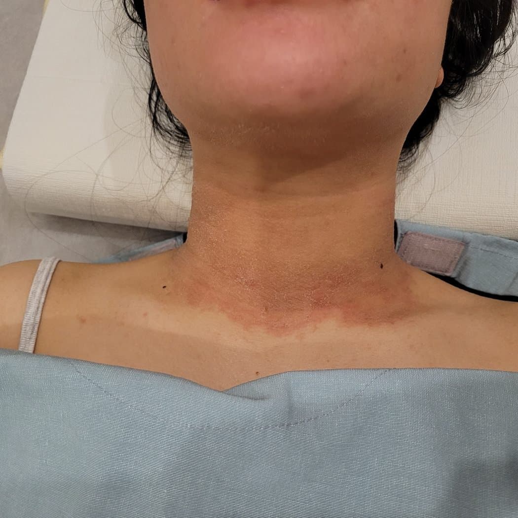지루성피부염 치료 전 증상 목과 가슴 부위