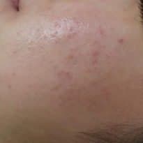 지루성피부염 치료 전 증상 볼 부위