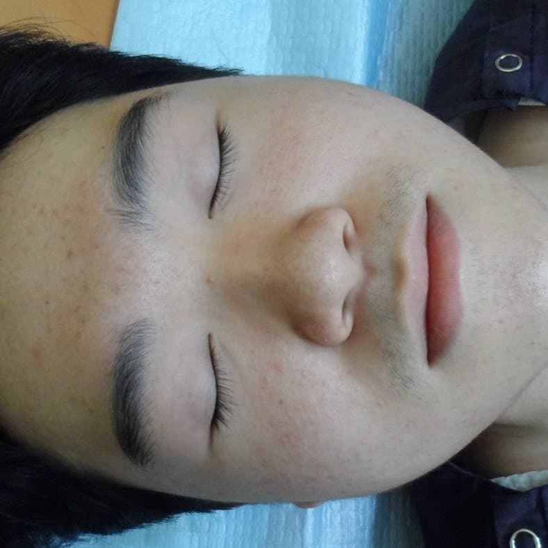 지루성피부염 치료 전 증상 얼굴 부위