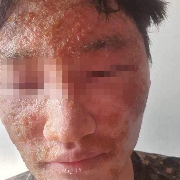 지루성피부염 치료 전 증상 얼굴 부위