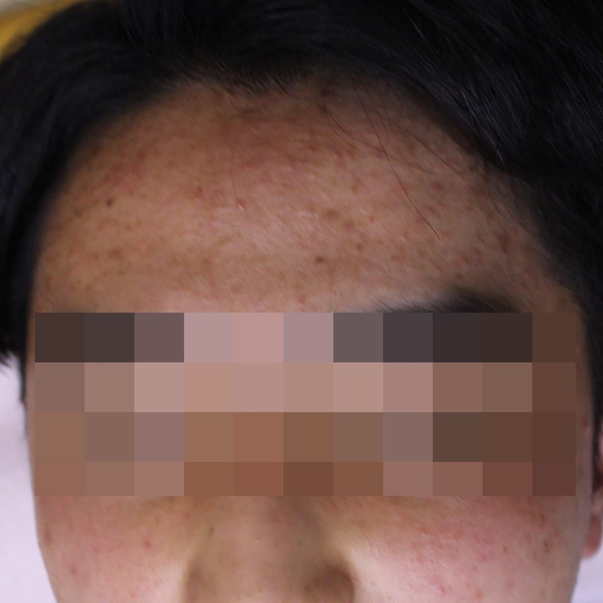 지루성피부염 치료 전 증상 얼굴 부위