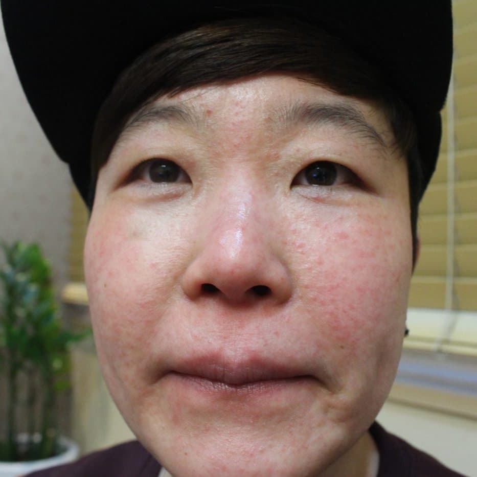 지루성피부염 치료 전 증상 얼굴 부위