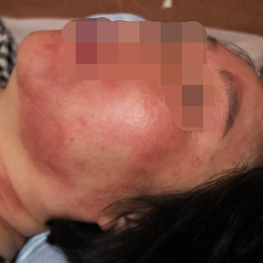 지루성피부염 치료 전 증상 얼굴 부위