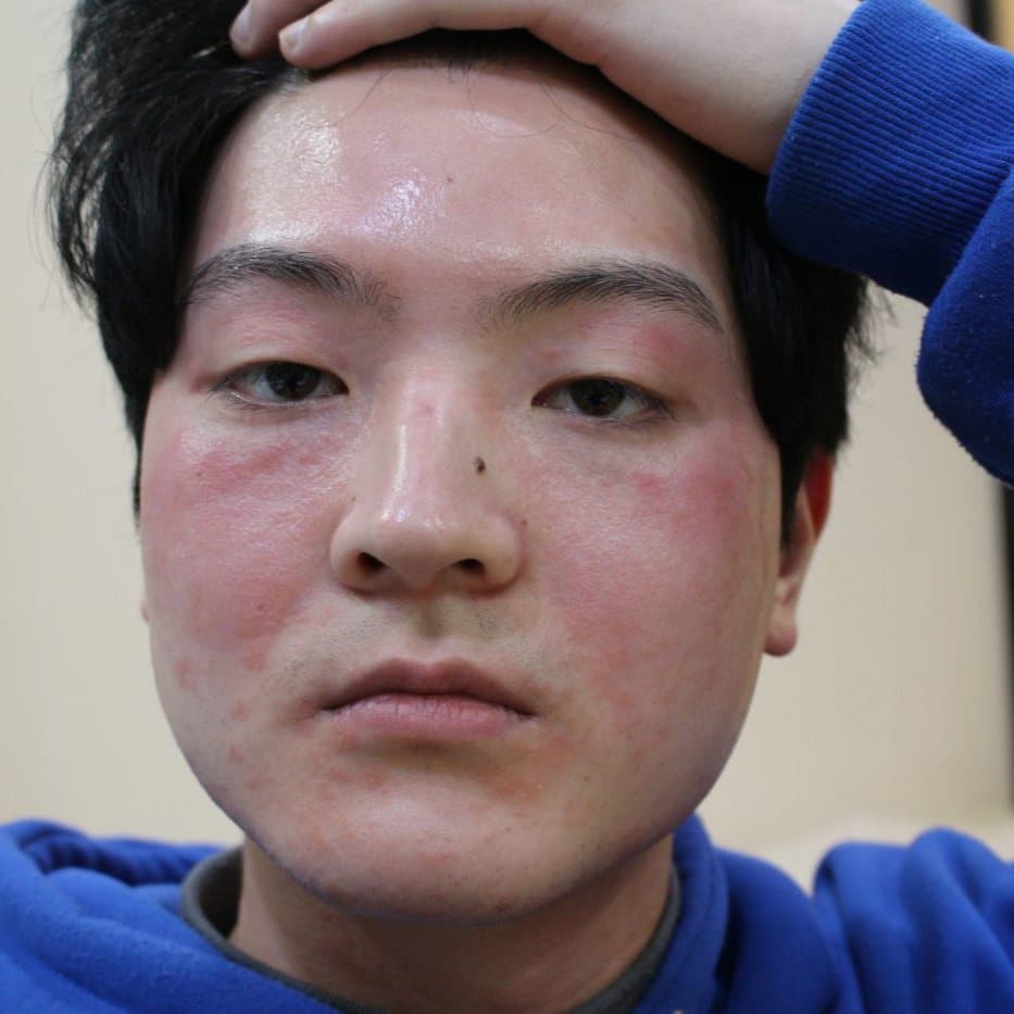 지루성피부염 치료 전 증상 얼굴 부위