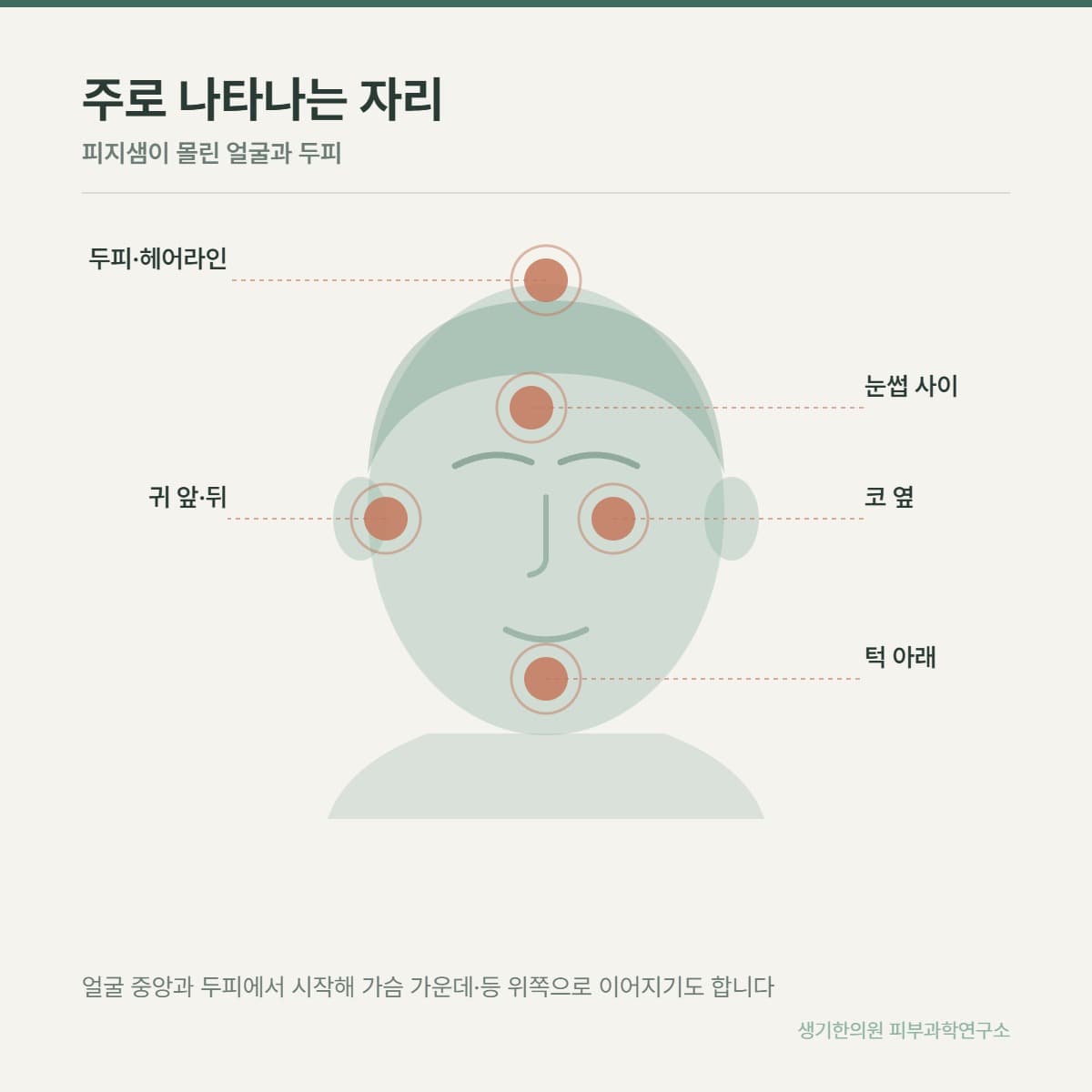 지루성피부염 호발 부위 안내 그림