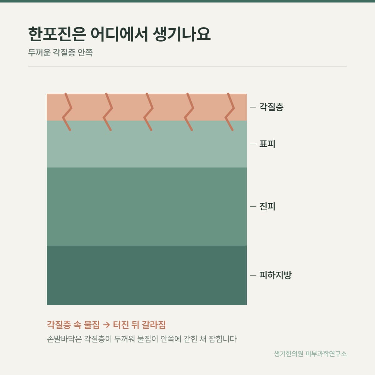 한포진 발생 구조 안내 그림