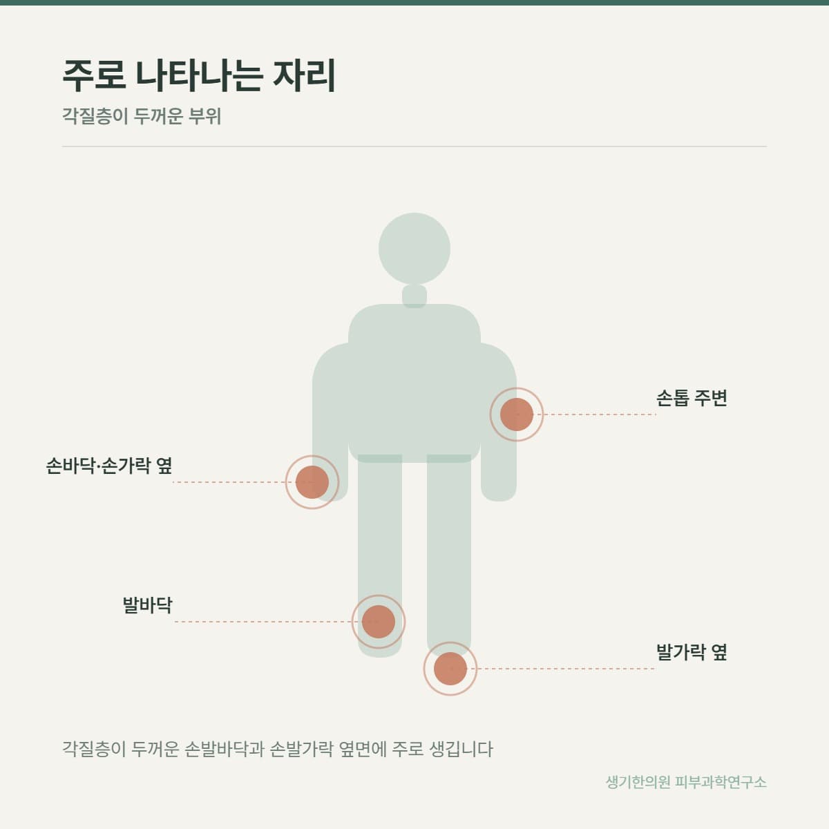 한포진 호발 부위 안내 그림