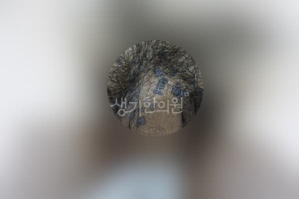 곤지름 치료 전 사진 — 광주점, 치료 기간 13개월