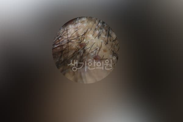 곤지름 치료 전 사진 — 광주점, 치료 기간 3개월