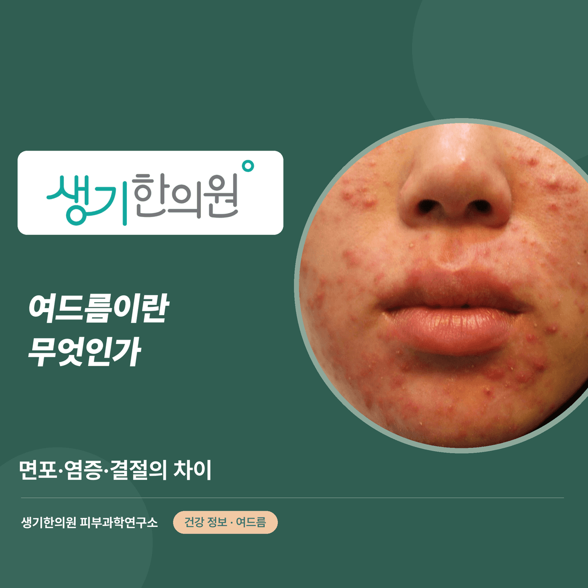 여드름이란 무엇인가 — 면포·염증·결절의 차이 대표 이미지