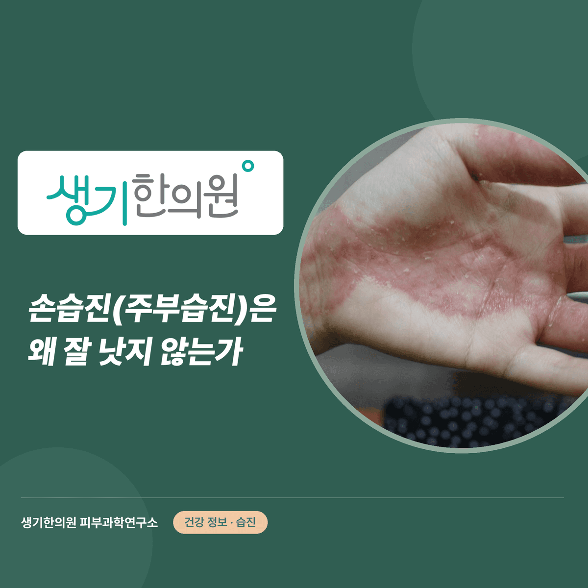 손습진(주부습진)은 왜 잘 낫지 않는가 대표 이미지