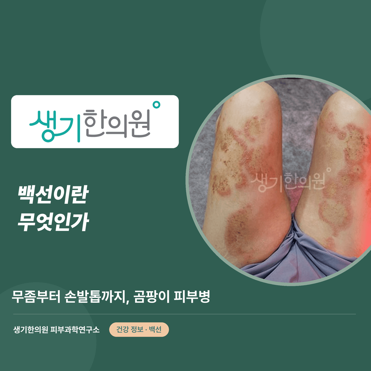 백선이란 무엇인가 — 무좀부터 손발톱까지, 곰팡이 피부병 대표 이미지
