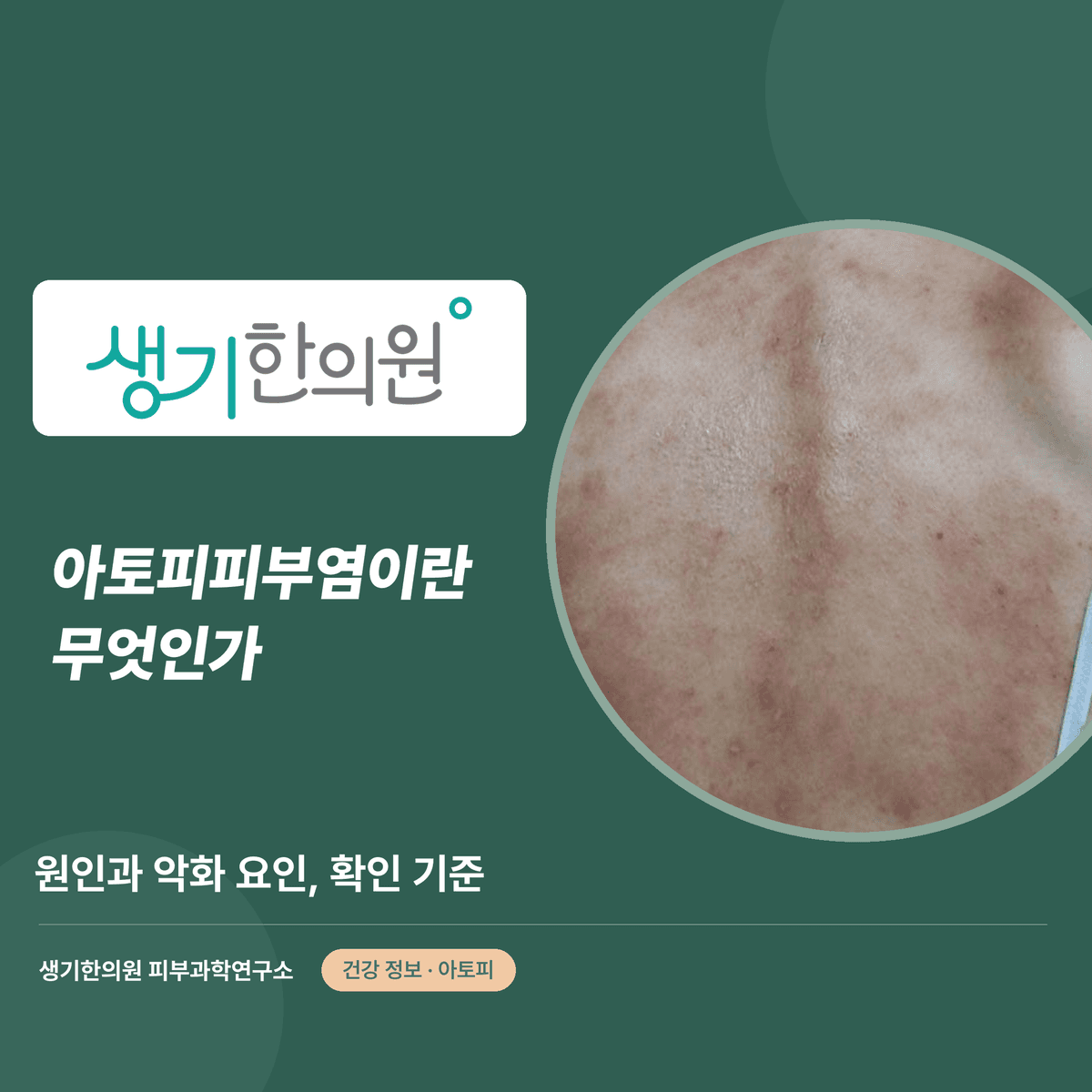 아토피피부염이란 무엇인가 — 원인과 악화 요인, 확인 기준 대표 이미지
