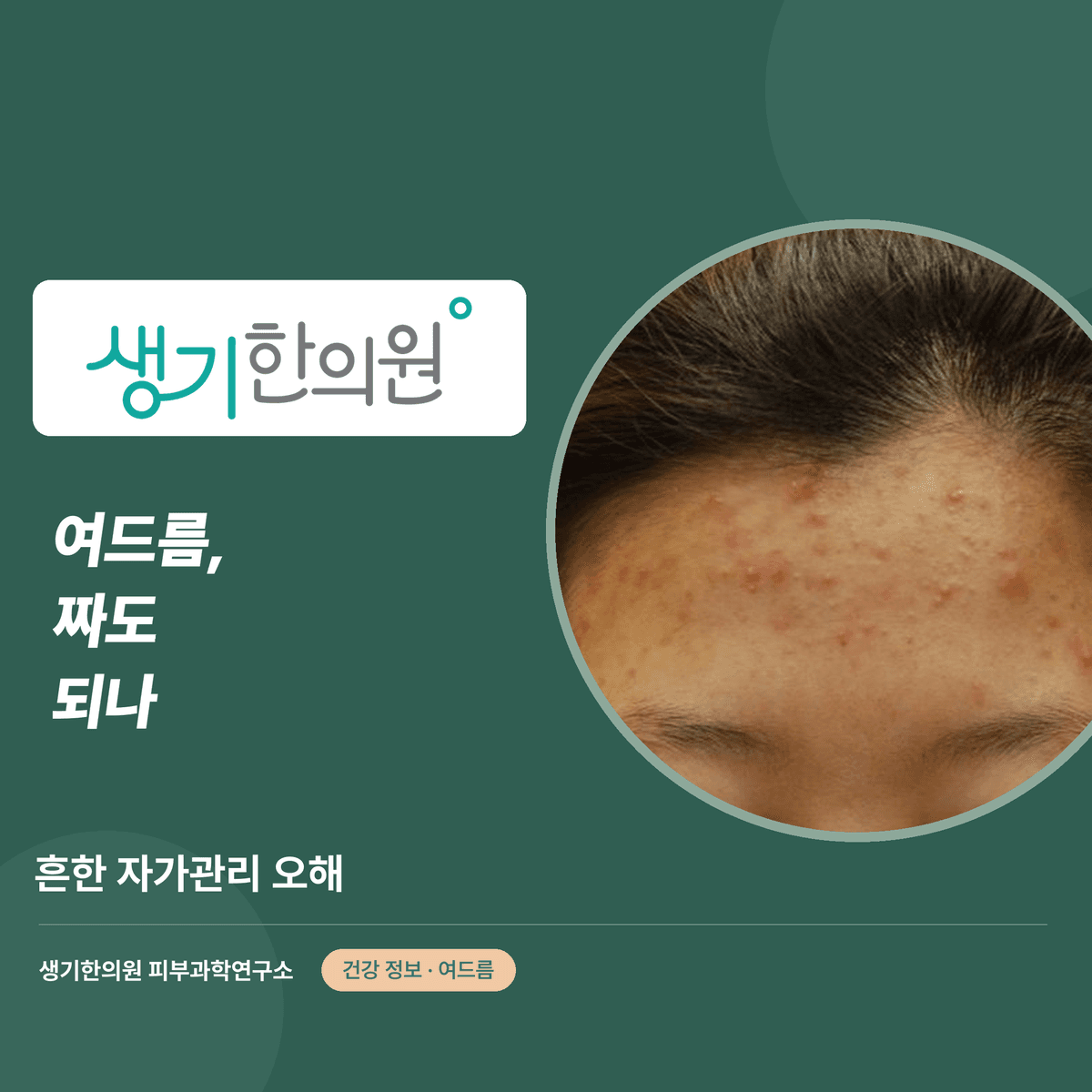 여드름, 짜도 되나 — 흔한 자가관리 오해 대표 이미지
