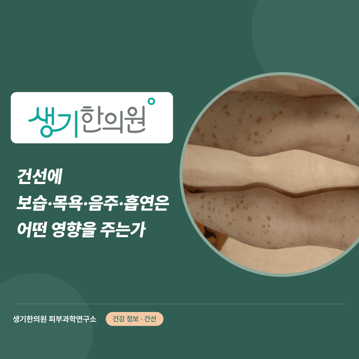 건선에 보습·목욕·음주·흡연은 어떤 영향을 주는가 대표 이미지