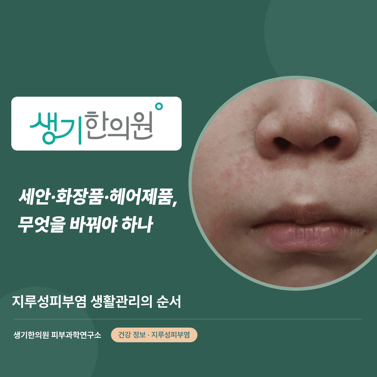 세안·화장품·헤어제품, 무엇을 바꿔야 하나 — 지루성피부염 생활관리의 순서 대표 이미지