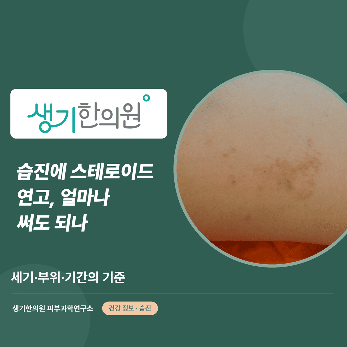 습진에 스테로이드 연고, 얼마나 써도 되나 — 세기·부위·기간의 기준 대표 이미지