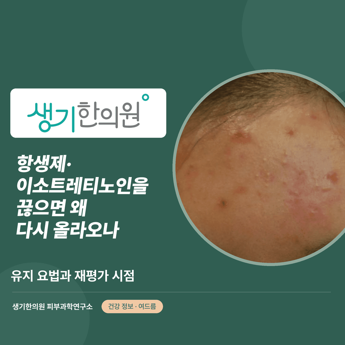 항생제·이소트레티노인을 끊으면 왜 다시 올라오나 — 유지 요법과 재평가 시점 대표 이미지