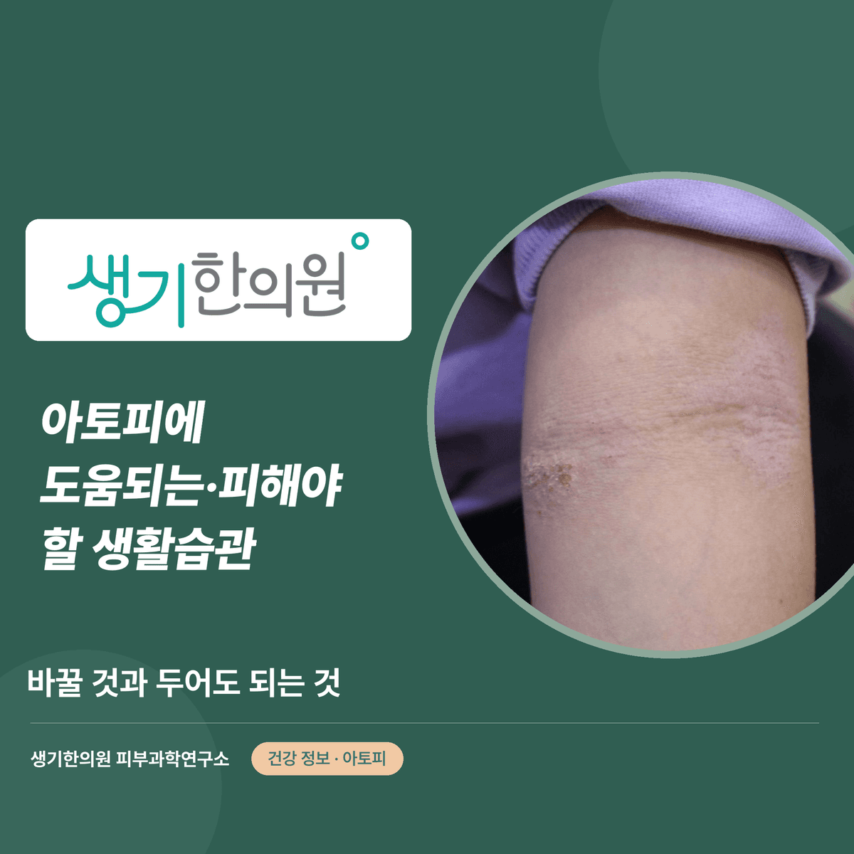 아토피에 도움되는·피해야 할 생활습관 — 바꿀 것과 두어도 되는 것 대표 이미지