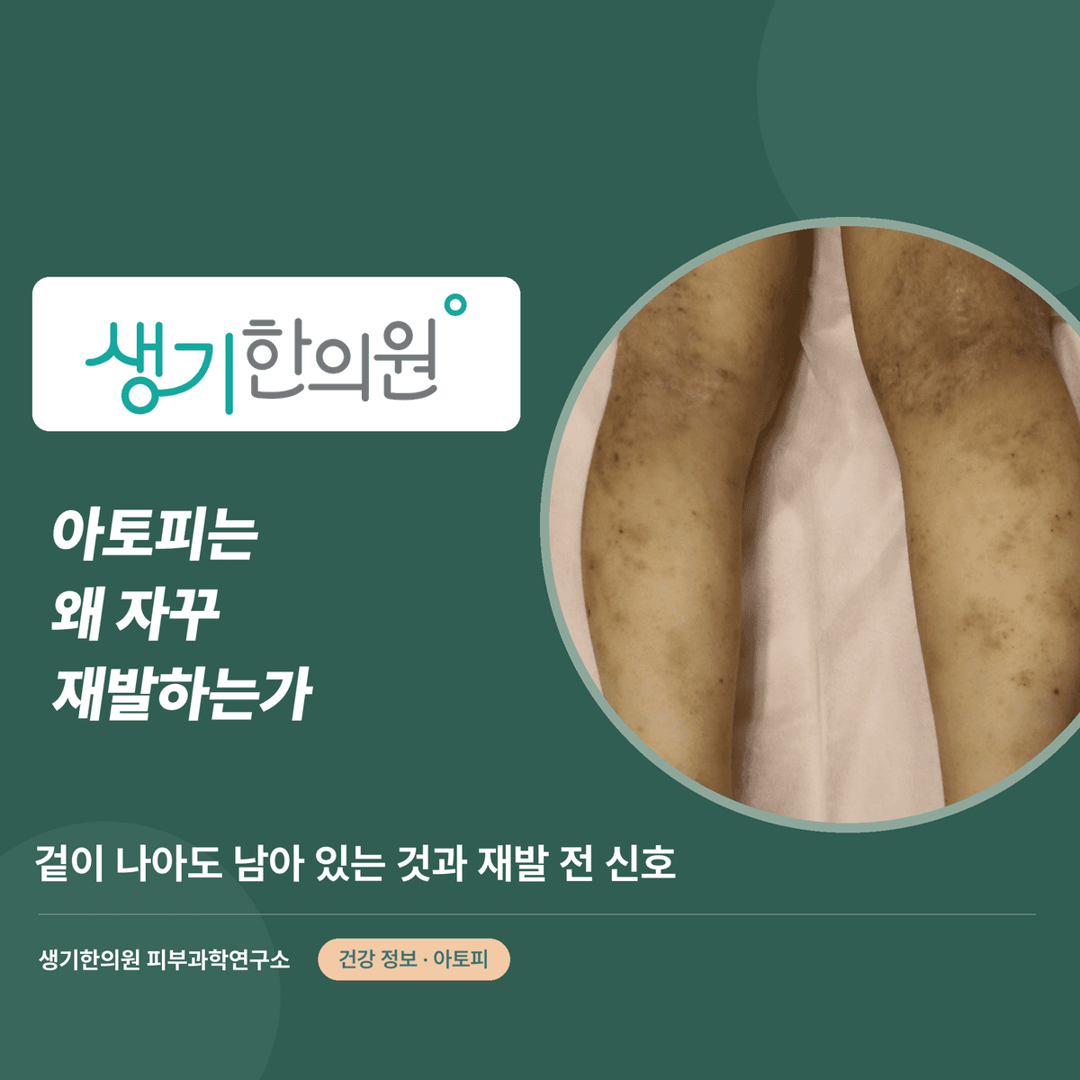 아토피는 왜 자꾸 재발하는가 — 겉이 나아도 남아 있는 것과 재발 전 신호 대표 이미지