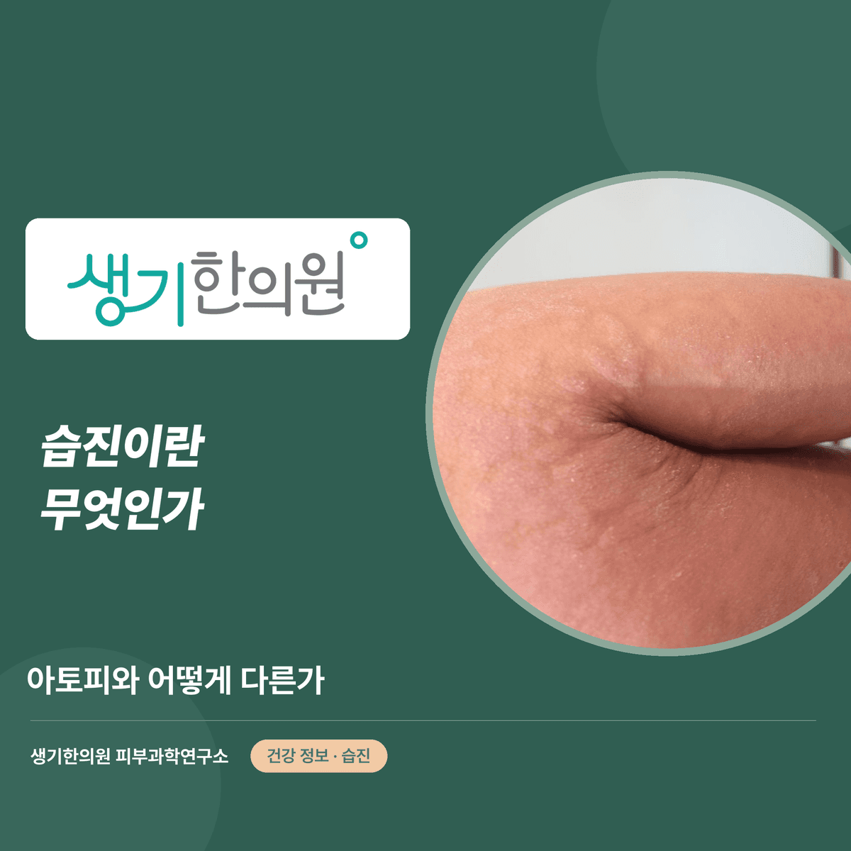습진이란 무엇인가 — 아토피와 어떻게 다른가 대표 이미지
