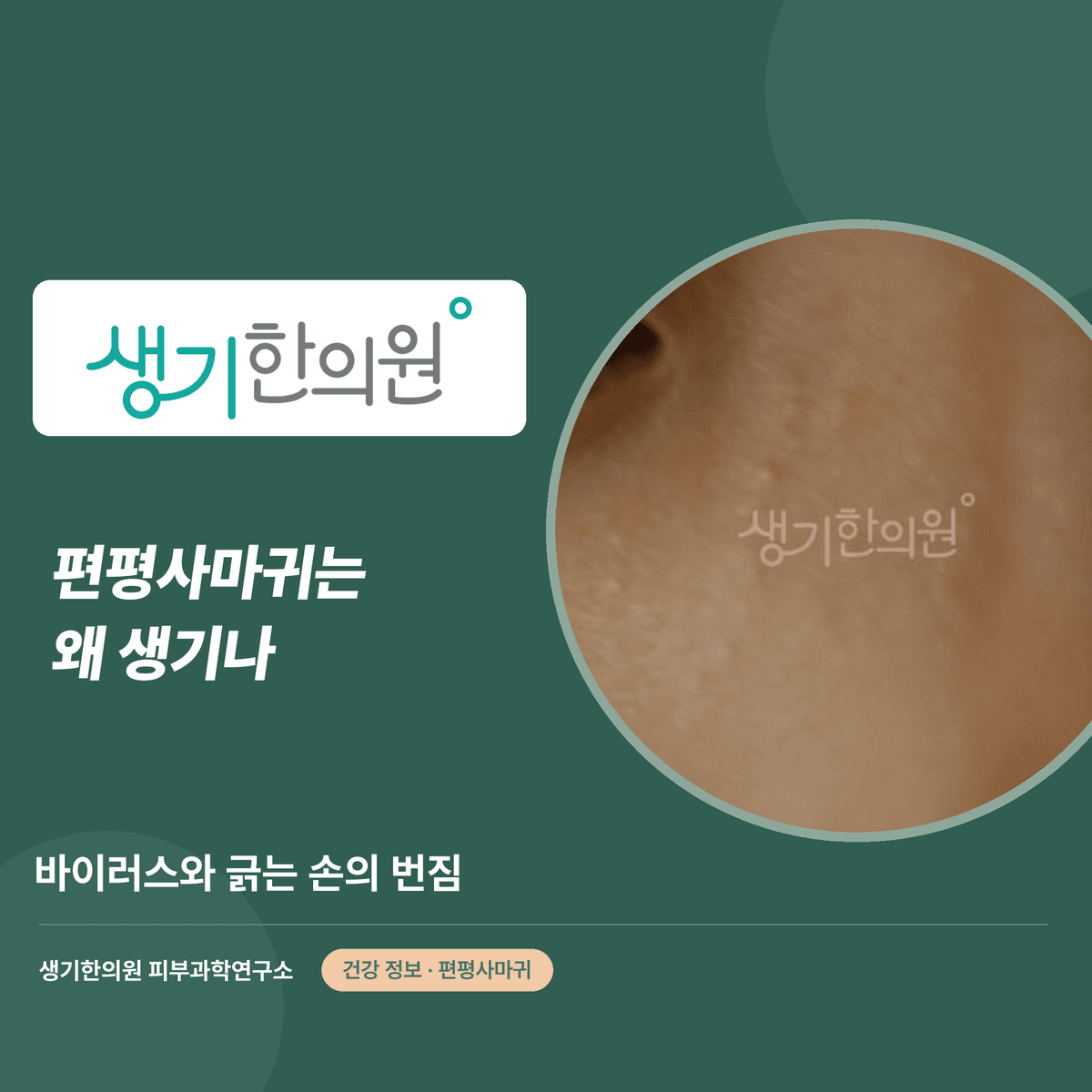 편평사마귀는 왜 생기나 — 바이러스와 긁는 손의 번짐 대표 이미지
