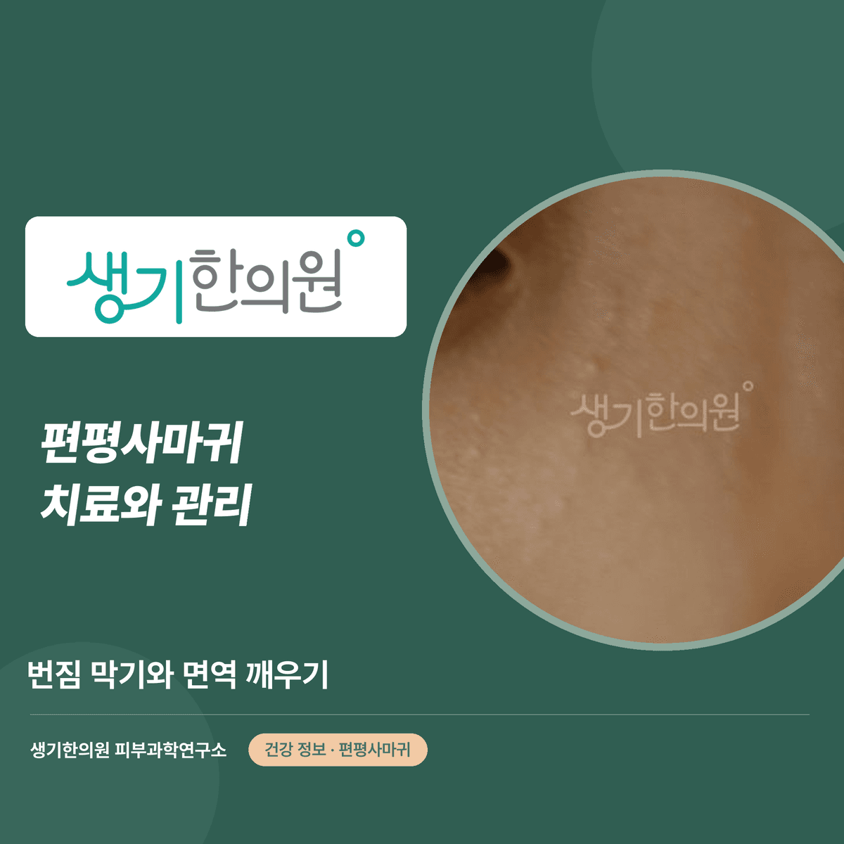 편평사마귀 치료와 관리 — 번짐 막기와 면역 깨우기 대표 이미지